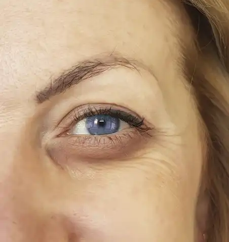 How to Combat Eye Bags and Dark Circles — Without Make-up
